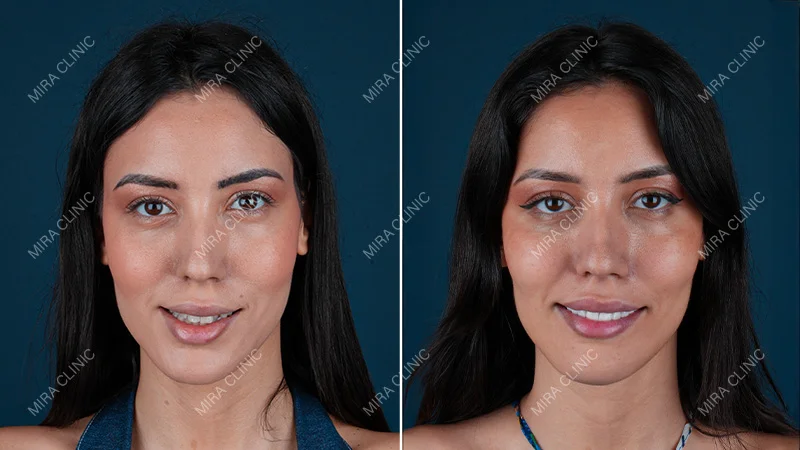 Saida Laabidi Hollywood Smile